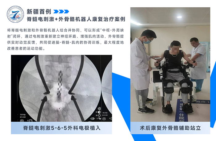 新疆醫科大學第七附屬醫院分享首例脊髓電刺激+外骨骼治療！